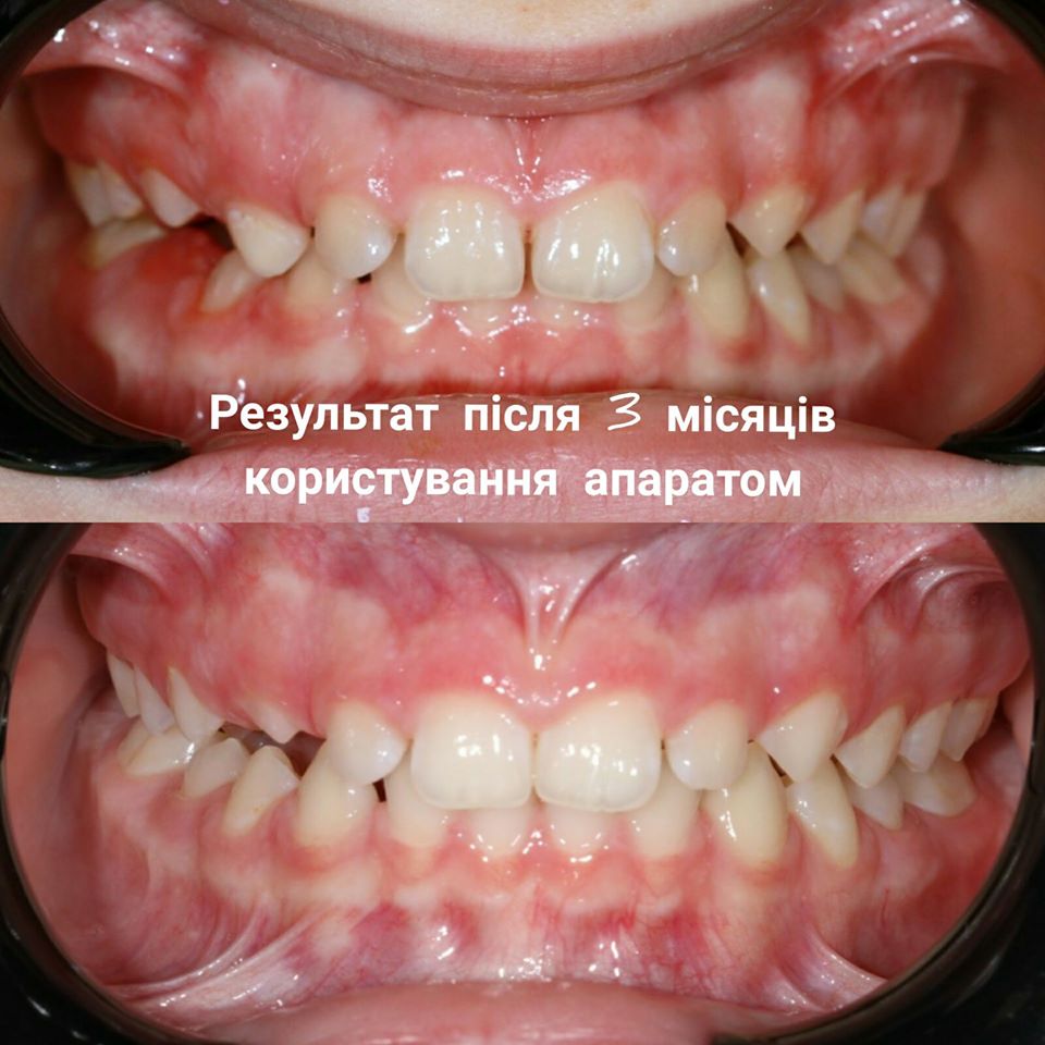 Ортодонтическое лечения в нашей клинике проводится с помощью специальных ортодонтических конструкций, благодаря которым изменяется положение зубов в зубном ряду, при этом нормализуется работа лицевых мышц и развитие челюстной кости.
